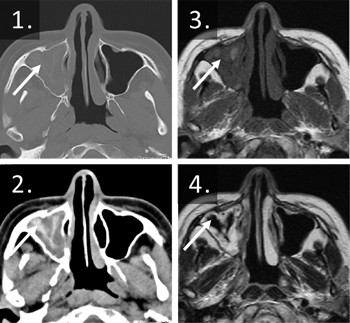 図2：アレルギー性真菌性副鼻腔炎の画像所見