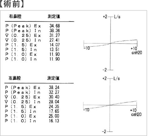 図4:鼻腔通気度検査による比較