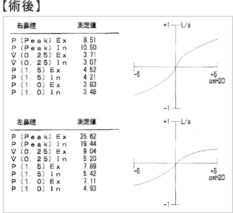 図4:鼻腔通気度検査による比較