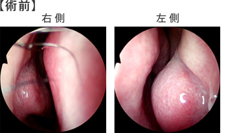 図3:鼻内内視鏡所見(術前、術後)