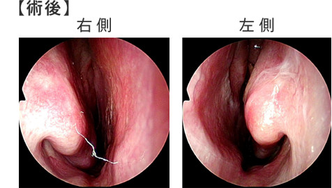 図3:鼻内内視鏡所見(術前、術後)