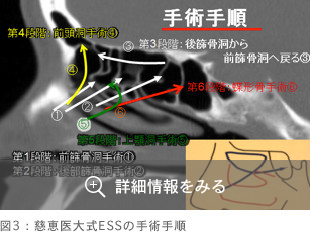 図3：慈恵医大式ESSの手術手順