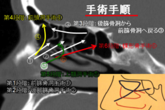 図3：慈恵医大式ESSの手術手順